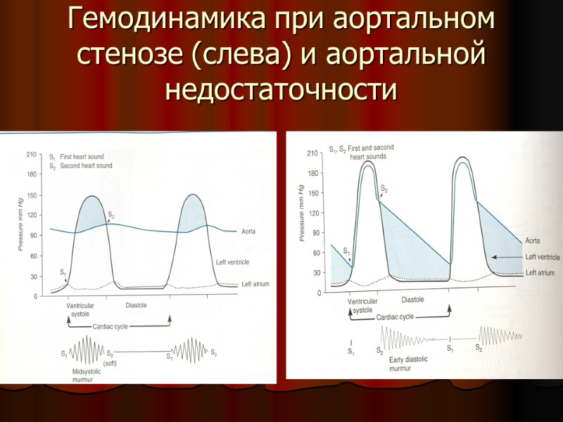 Гемодинамика при аортальном стенозе (слева) и аортальной недостаточности